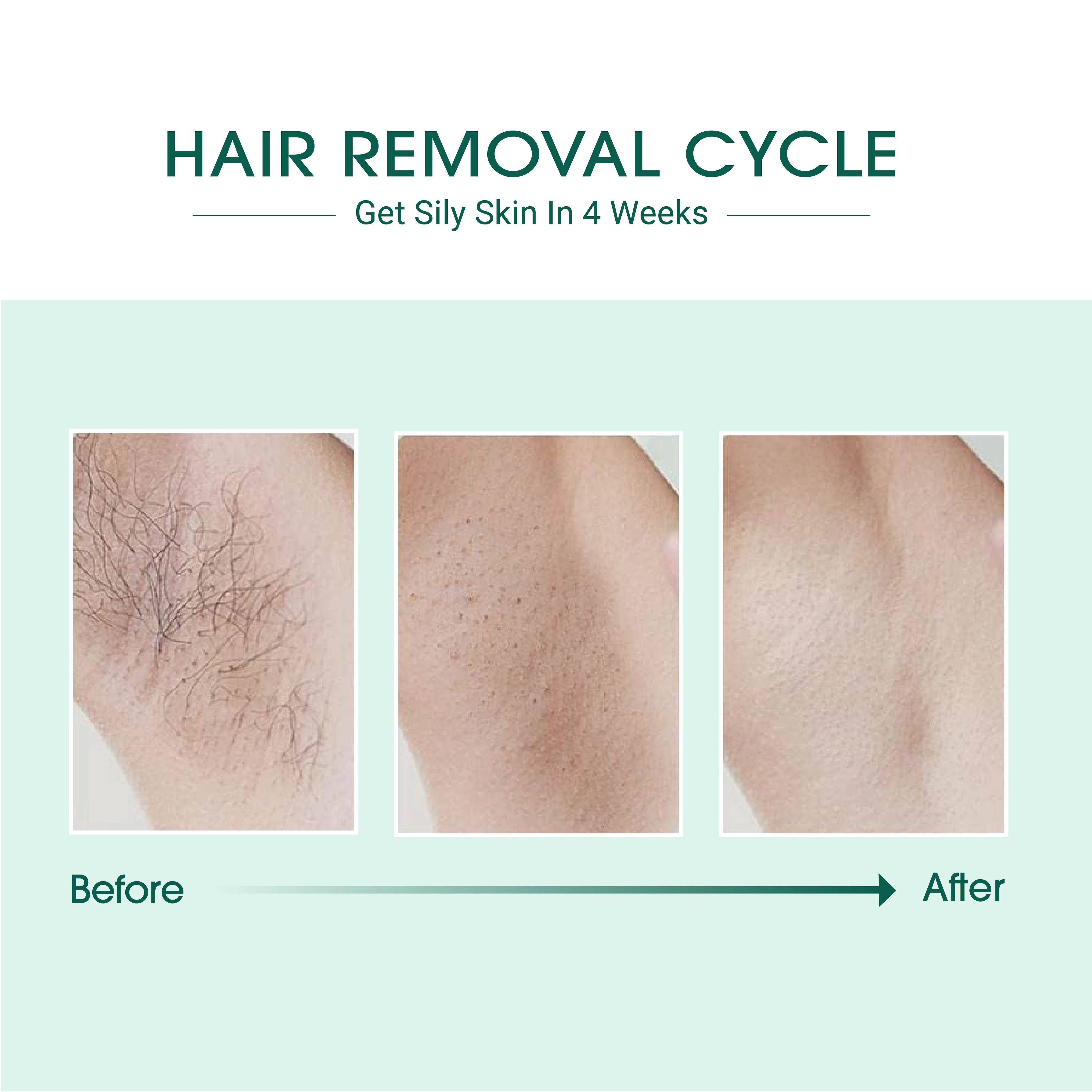 Laser IPL Hair Removal-thumbmail-3